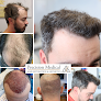 Your hair transplant and cost Precision Medical Hair Restoration & Aesthetics in Albuquerque in Bernalillo