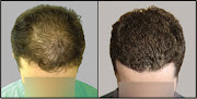Your hair transplant and cost Providence Hair Restoration Center in Providence in Rhode Island