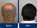 Your hair transplant and cost Pure Hair Restoration Center in Newport Beach in California