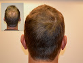 Your hair transplant and cost Raleigh Hair Transplants in Raleigh in North Carolina