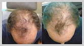 Your hair transplant and cost Rapaport Hair Institute In New Jersey - Englewood in Englewood Cliffs in New Jersey