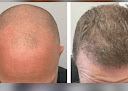 Your hair transplant and cost Regency Hair Restoration in Barrington in IL