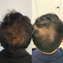 Your hair transplant and cost Rejuvla in Los Angeles in California