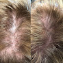 Your hair transplant and cost Remedy Hair Restoration & Medical Spa in Grand Rapids in Michigan