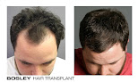 Your hair transplant and cost Richard Halford, M.d. - Bosley in Minnetonka in Minnesota