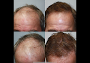 Your hair transplant and cost Rosanelli Medical Associates in San Francisco in California