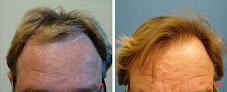 Your hair transplant and cost Sacramento Hair Doctor in Roseville in California
