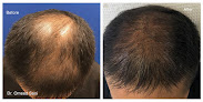 Your hair transplant and cost Sani Institute For Hair Restoration - Prp Therapy - San Jose in San Jose in California