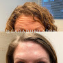 Your hair transplant and cost Sara Dunlap, Rn in Anchorage in AK