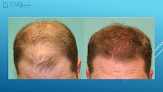 Your hair transplant and cost Sara Wasserbauer, Md in San Francisco in California