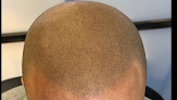Your hair transplant and cost Scalp Authority 24/7 Scalp Micropigmentation Michigan Emergency in Farmington Hills in Michigan