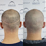 Your hair transplant and cost Scalp Co. Scalp Micropigmentation in Sacramento in California