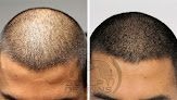 Your hair transplant and cost Scalp Designs in Stoughton in Massachusetts
