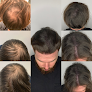 Your hair transplant and cost Scalp Headquarters Llc in Kansas City in MO