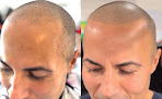 Your hair transplant and cost Scalp Impressions in Holyoke in Massachusetts