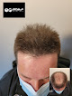 Your hair transplant and cost Scalp International Hairlines North Carolina in Raleigh in North Carolina