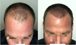 Your hair transplant and cost Scalp Masters Atlanta in Atlanta in Georgia