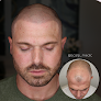 Your hair transplant and cost Scalp-Medic in Johns Creek in Georgia