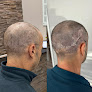 Your hair transplant and cost Scalp Micro Boise in Garden City in Idaho