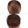 Your hair transplant and cost Scalp Micro Pro Clinic in Greensboro in North Carolina