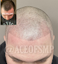 Your hair transplant and cost Scalp Micropigmentation in Merrillville in IN