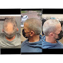 Your hair transplant and cost Scalp Micropigmentation Dallas in Dallas in Texas