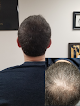 Your hair transplant and cost Scalp Micropigmentation in Kensington in Maryland