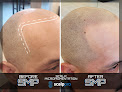 Your hair transplant and cost Scalp Pro in Sioux Falls in South Dakota
