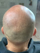 Your hair transplant and cost Scalp Prodigy in Las Vegas in Nevada