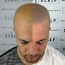 Your hair transplant and cost Scalp Society - Scalp Micropigmentation Clinic in San Jose in California