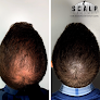 Your hair transplant and cost Scalp Society in San Francisco in California
