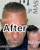 Your hair transplant and cost Scalpmasters - Scalp Micropigmentation Hair Clinic in Cranston in Rhode Island