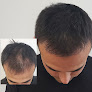 Your hair transplant and cost Scalpp Clinic : Scalp Micropigmentation Houston in Houston in Texas
