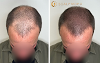 Your hair transplant and cost Scalpworx in Sandy Springs in Georgia