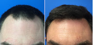 Your hair transplant and cost Scott A. Boden, Md in Wethersfield in Connecticut