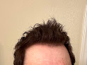 Your hair transplant and cost Scott Alexander, Md in Phoenix in AZ