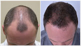 Your hair transplant and cost Scottsdale Institue For Cosmetic Dermatology: Dr. Shelly Friedman in Scottsdale in AZ