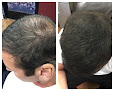 Your hair transplant and cost Semper Hair Clinic Llc in Fresno in California