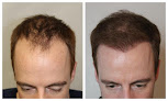 Your hair transplant and cost Silicon Valley Hair Institute in Foster City in California