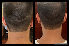 Your hair transplant and cost Sladeksmp- Iowa City in Coralville in IA