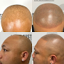 Your hair transplant and cost Smp Of Austin in Austin in Texas