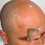 Your hair transplant and cost Smp Scalp Micropigmentation By Meechididit in Lansing in IL