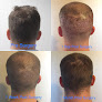 Your hair transplant and cost Solve Clinics Hair Transplant Chicago in Skokie in Illinois