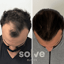 Your hair transplant and cost Solve Clinics Hair Transplant New York in New York in New York