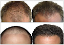 Your hair transplant and cost Stoller Medical Group in New York in New York