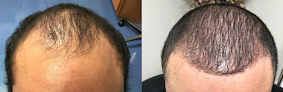 Your hair transplant and cost Tampa Bay Hair Restoration in Clearwater in Florida