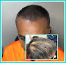 Your hair transplant and cost Tampa Scalp Ink in Oldsmar in Florida