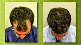Your hair transplant and cost Tempus Hair Restoration in Tampa in Florida