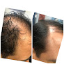 Your hair transplant and cost Texas Hair Restoration And Wellness Center in Houston in Texas