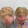 Your hair transplant and cost Texas Hair Restoration Center in Austin in Texas